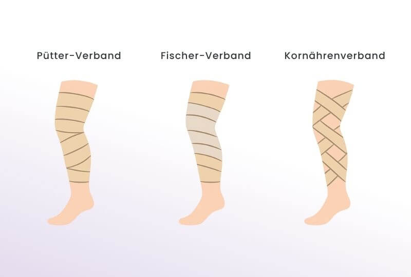 Illustration von drei verschiedenen Techniken der Kompressionstherapie: Pütter-Verband, Fischer-Verband und Kornährenverband am Bein.