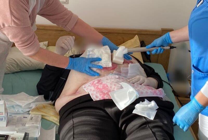 Kaltplasmatherapie wird bei einem Patienten, durch zwei Personen, Angehörige und vom Pflegedienst am Bauch durchgeführt.