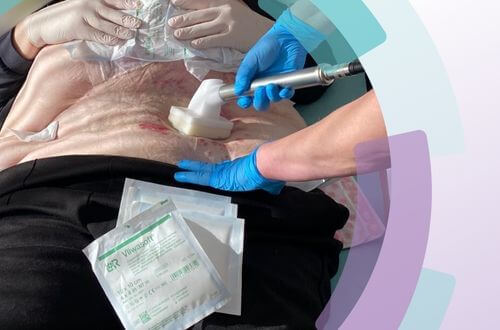 Kaltplasmatherapie bei einem älteren Patienten am Bauch.