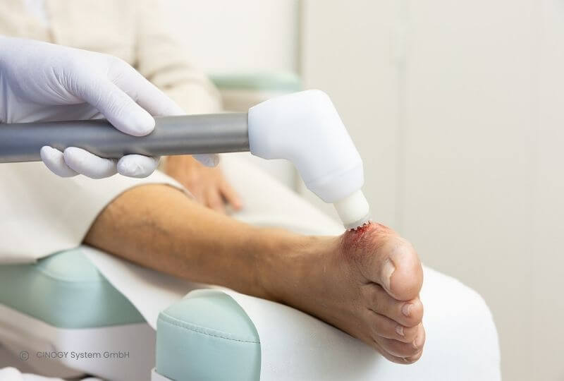 Kaltplasma wird am Fuß einer Patientin durchgeführt.