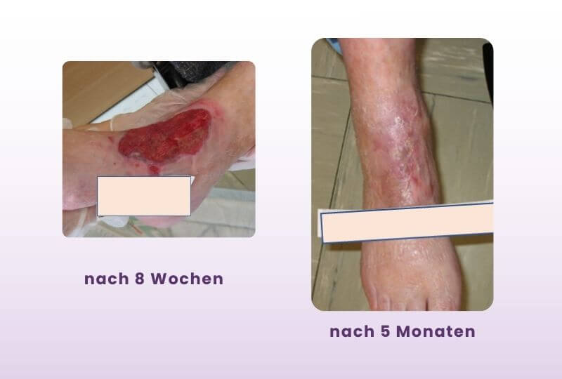 Wunde durch zirkuläre Fixierung. Fallbeispiel von Ulrike Wagner. Bild nach 8 Wochen in der Versorgung und Bild der Wunde nach 5 Monaten