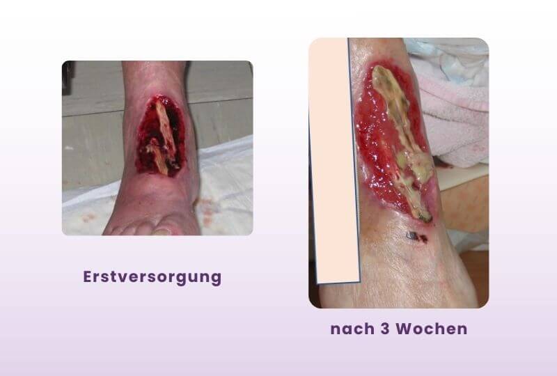 Wunde durch zirkuläre Fixierung. Fallbeispiel von Ulrike Wagner. Bild bei Erstversorgung und Bild der Wunde nach 3 Wochen.