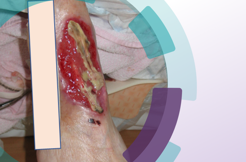 Fallbeispiel: Dekubitus an der Ferse