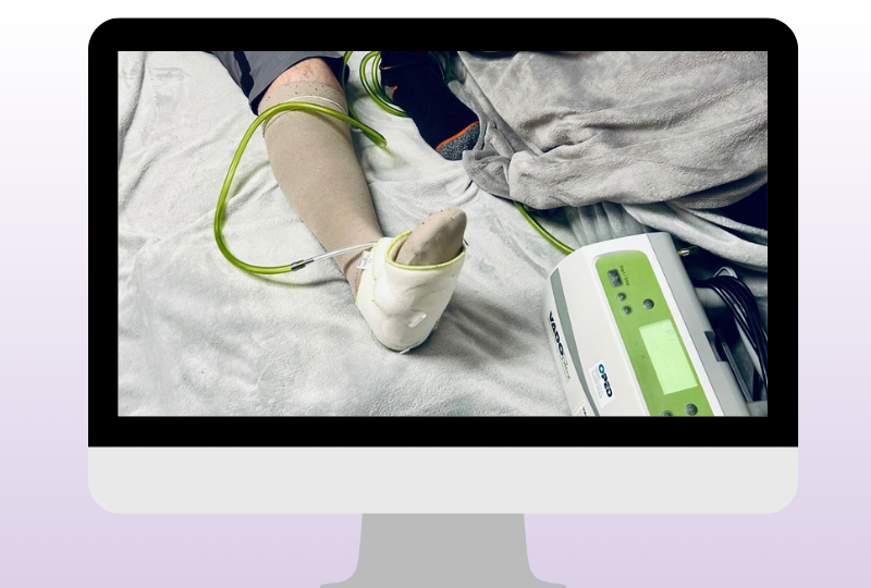 Anwendung der VADOplex im häuslichen Umfeld des Patienten mit Wundheilungsstörung und Ödem trotz Kompression.