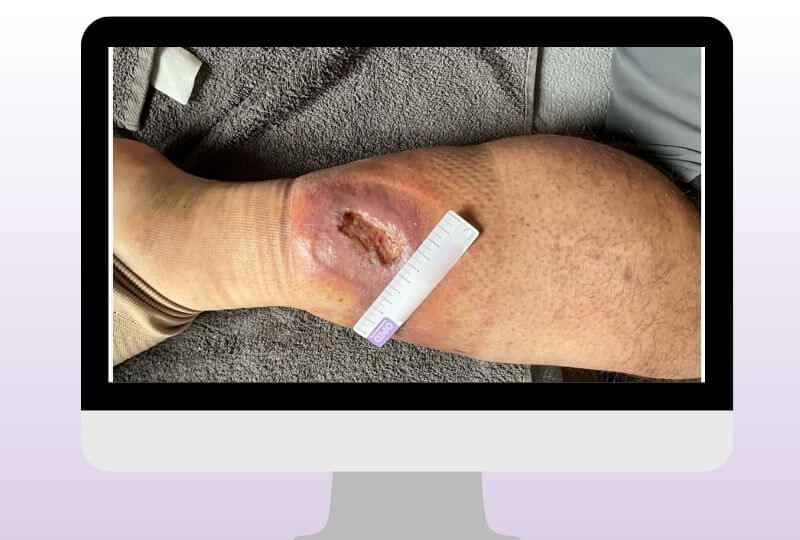 Wunde (Ödem und Wundheilungsstörungen) am Stumpf beim Patienten, männlich 30. Beginn der Behandlung bei OPED Wundversorgung