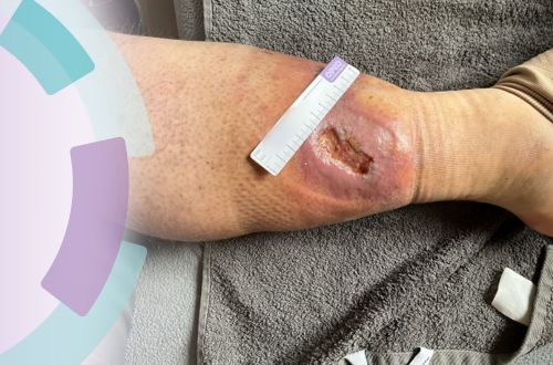 Wunde am Stumpf bei einem Patient, männlich, 30. Wundheilungsstörungen und Ödem trotz Kompression.