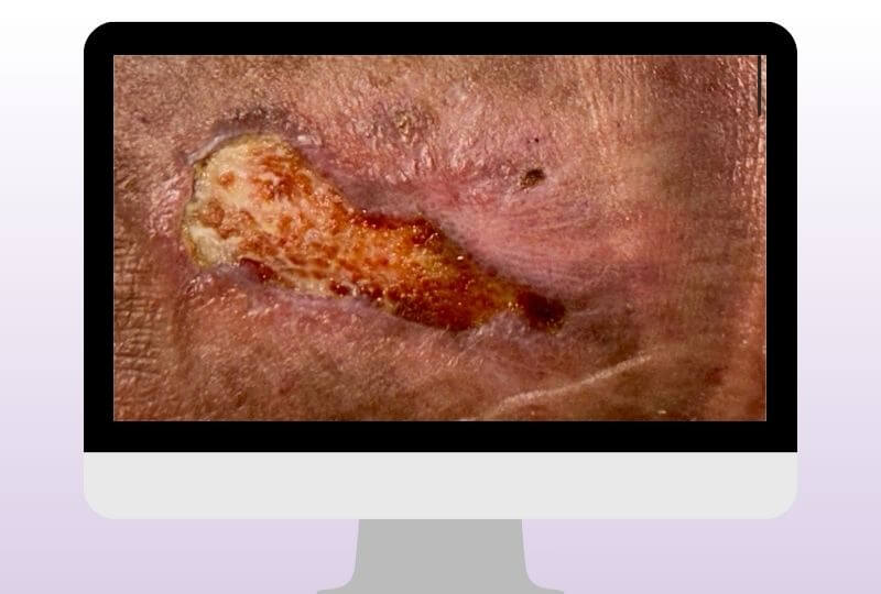 Wunde des Patienten nach einer 3 monatigen Behandlung und der Behandlung mit VADOplex. Wundheilungsstörung & Ödem verbessert.