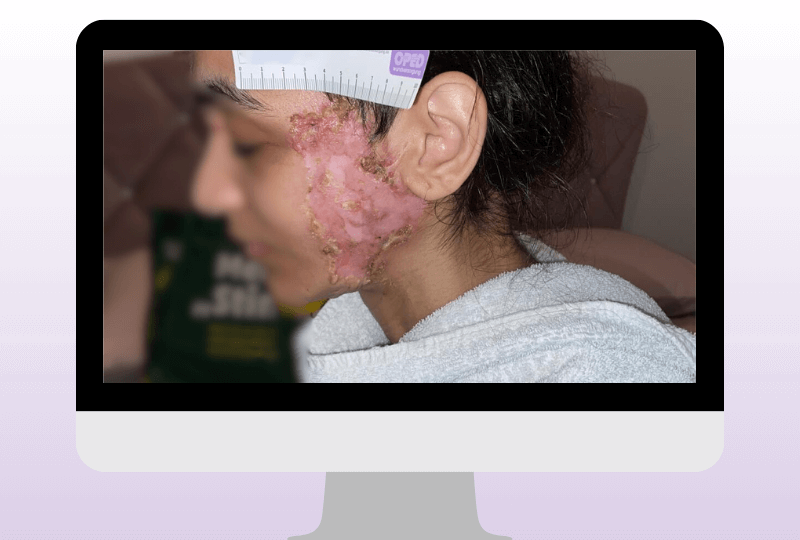 Beginnender Heilungsverlauf unter strukturierter Wundtherapie. Eine konsequente interdisziplinäre Betreuung ist entscheidend, um Schmerzen zu reduzieren und die Wundstabilisierung zu fördern.