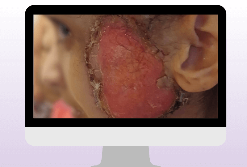 Deutlich sichtbare entzündliche Hautveränderung im Wangenbereich bei Pyoderma gangraenosum. Die Erkrankung zeigt sich häufig durch schmerzhafte, flächige Ulzerationen mit ausgeprägter Rötung.