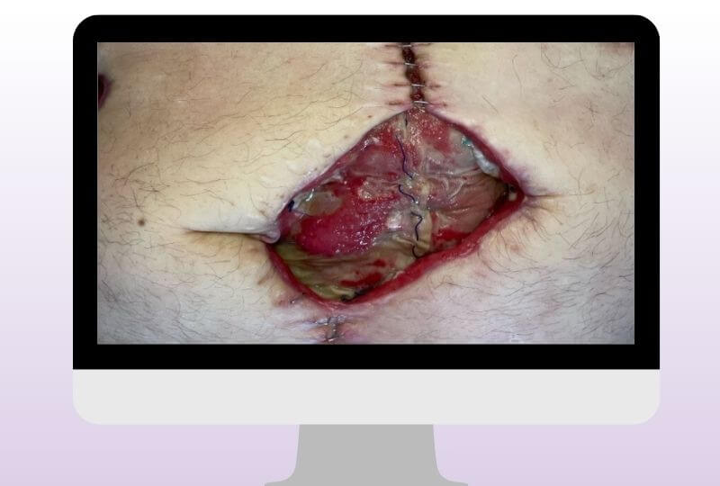 Tiefe postoperative Wunde mit Nahtmaterial, fibrinösen Belägen und entzündlich verändertem Wundrand