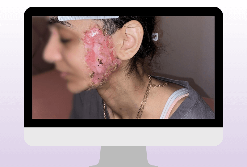 Fortschreitende Ausprägung der entzündlichen Läsion mit deutlicher Gewebereaktion. Pyoderma gangraenosum kann sich rasch verändern und erfordert eine engmaschige, individuell angepasste Versorgung.