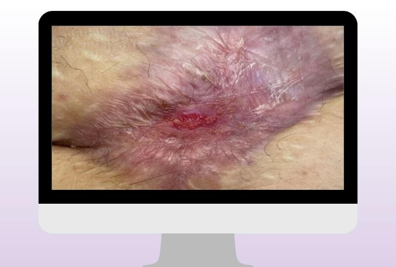 Deutlich verkleinerte postoperative Wunde mit fortgeschrittener Granulation und beginnender Epithelisierung