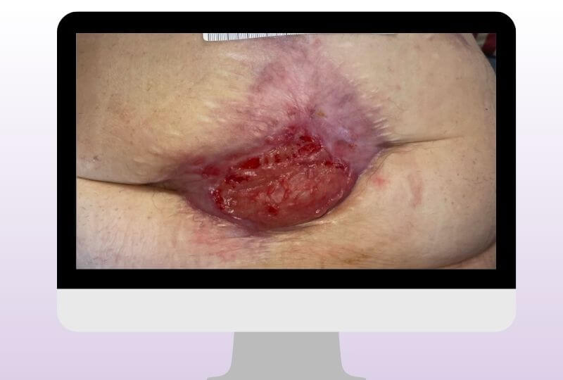 Ausgedehnte postoperative Wundheilungsstörung mit starker Exsudation und freiliegendem Wundgrund