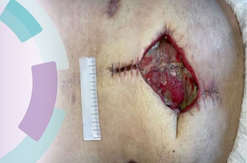 postoperative Wundheilungsstörung