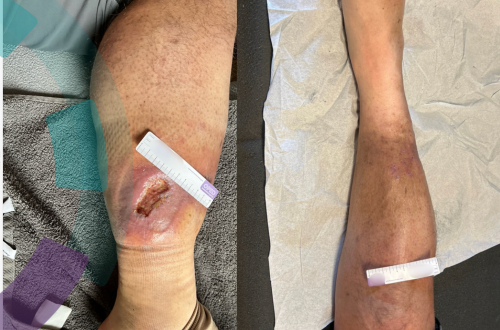 Postoperative Wundheilungsstörung am Unterschenkel mit ausgeprägtem Ödem bei einem 30-jährigen Patienten im Behandlungsverlauf – Vergleich vor und während der Therapie mit sichtbarer Reduktion der Schwellung