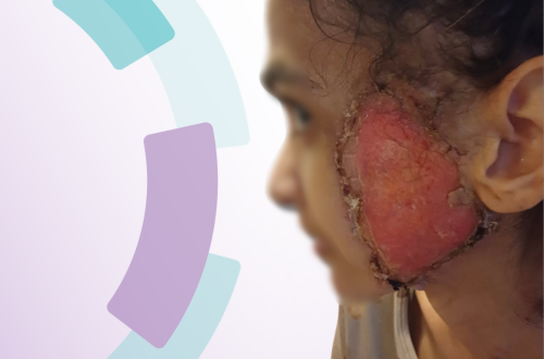 Seltene Erkrankung, komplexe Versorgung: Dieses Fallbeispiel zeigt die Behandlung von Pyoderma gangraenosum im Gesicht. Erfahren Sie, wie interdisziplinäre Wundversorgung, Materialwahl und Zusammenarbeit den Heilungsverlauf beeinflussen.